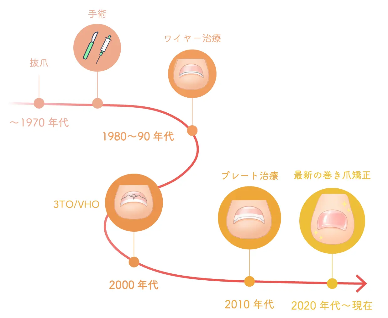 巻き爪治療の変遷