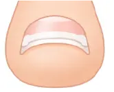 巻き爪矯正３