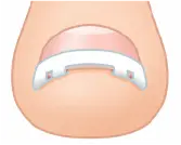 巻き爪矯正４