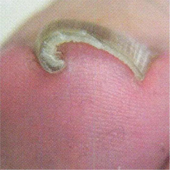 折り返し型の巻き爪の治療法