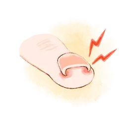 巻き爪治療のイラスト①