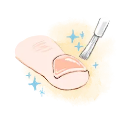 巻き爪治療のイラスト