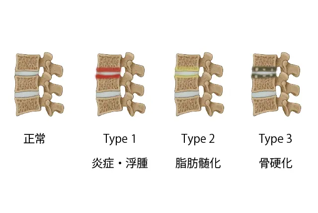 金沢市のアスリート必見|椎体終板障害による腰痛と最新リハビリ法を徹底解説