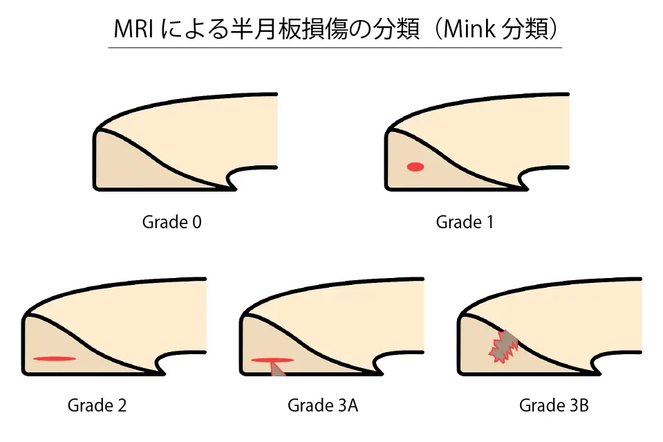 MRIによる半月板損傷の分類