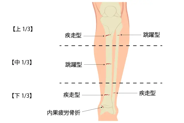 下腿疲労骨折の分類