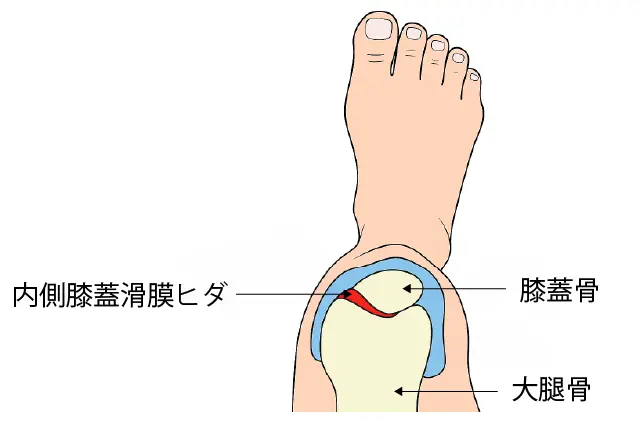 内側膝蓋滑膜ヒダ（上から見た図）