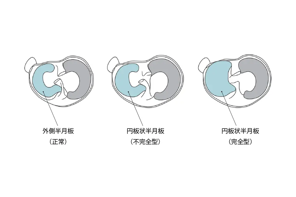 円板状半月板