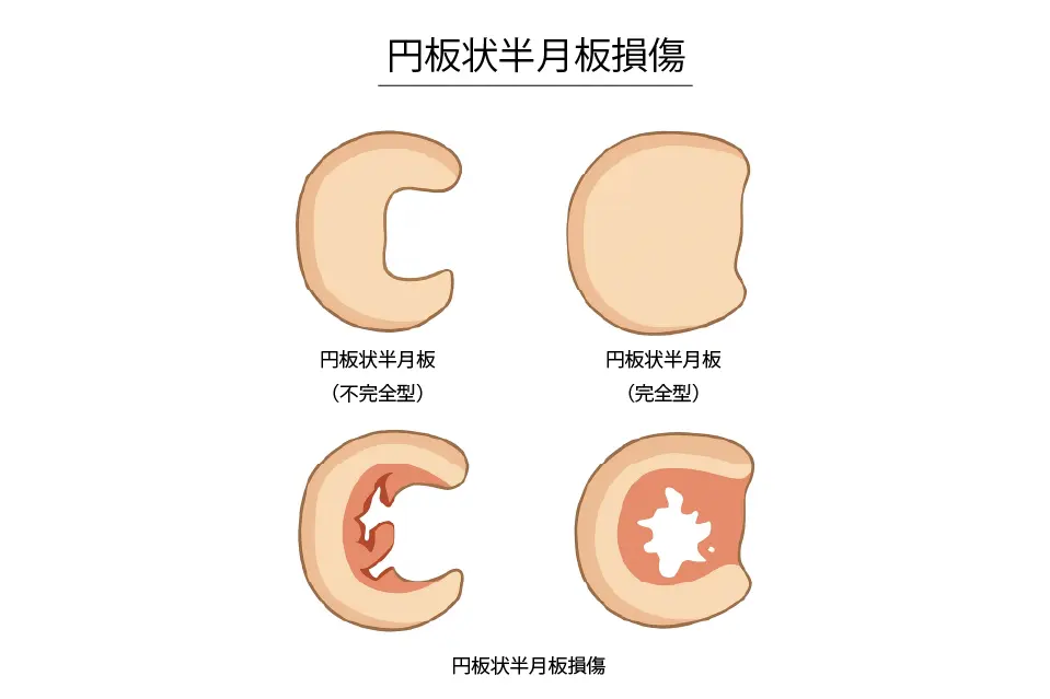 円板状半月板損傷