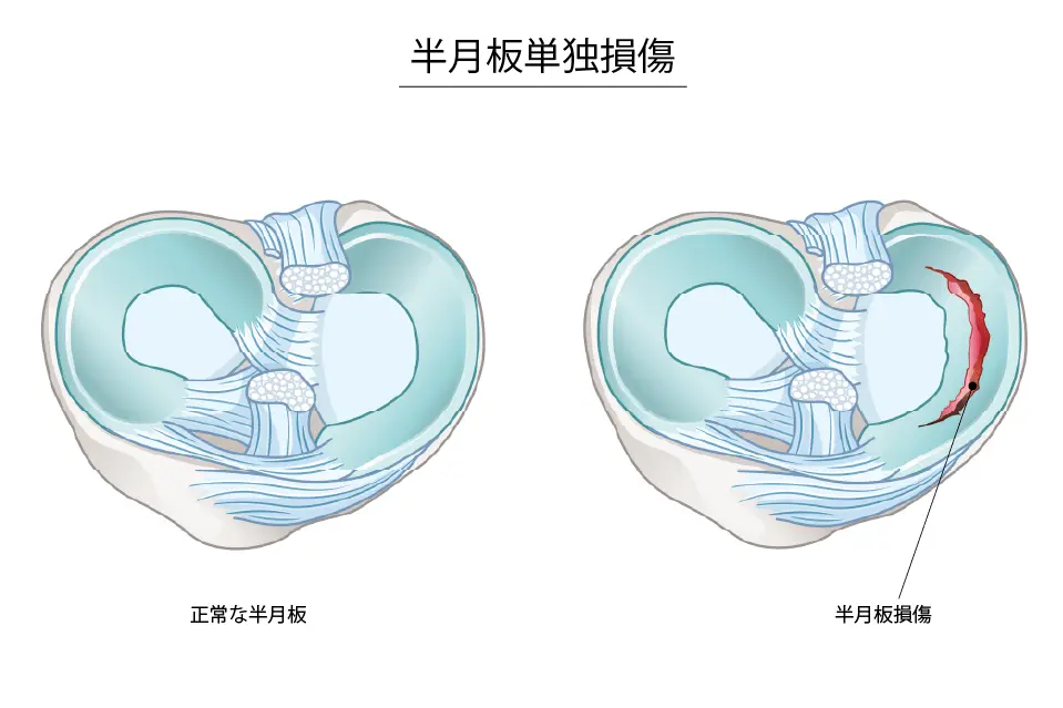 半月板単独損傷
