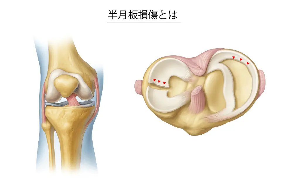 半月板損傷とは