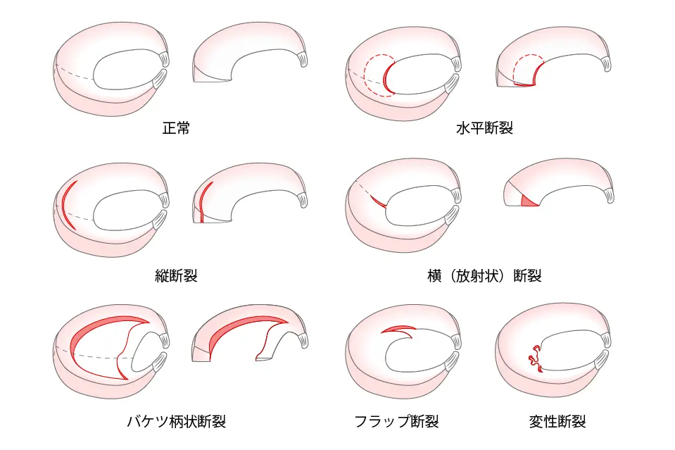 半月板損傷のタイプ