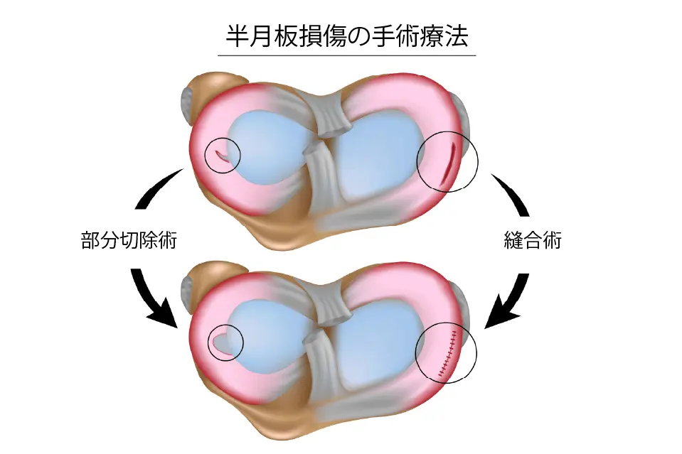 半月板損傷の手術