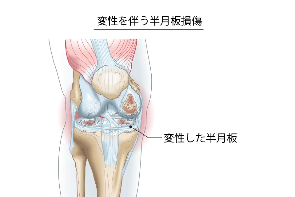 変性を伴う半月板損傷
