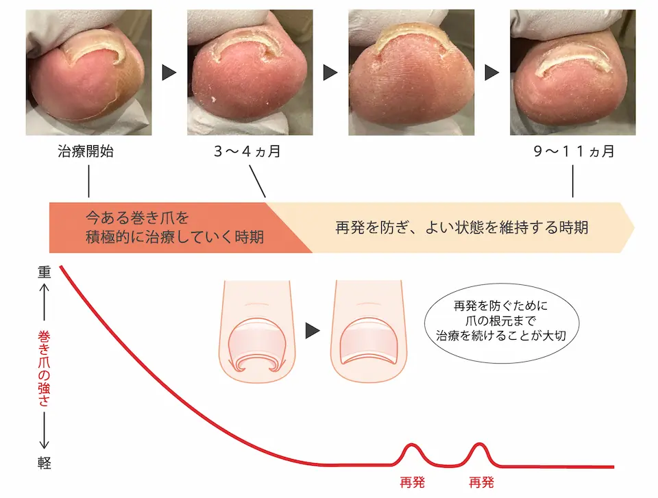巻き爪矯正再発予防