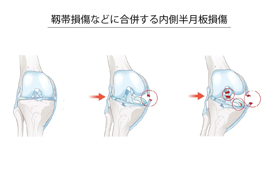 靱帯損傷などに合併する内側半月板損傷