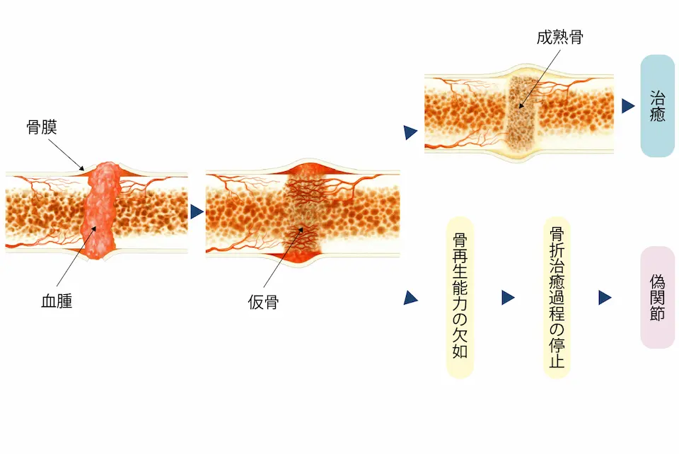 偽関節とは