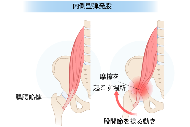 内側型弾発股のイラス