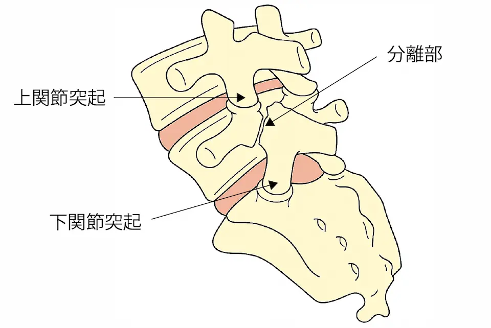分離症とは