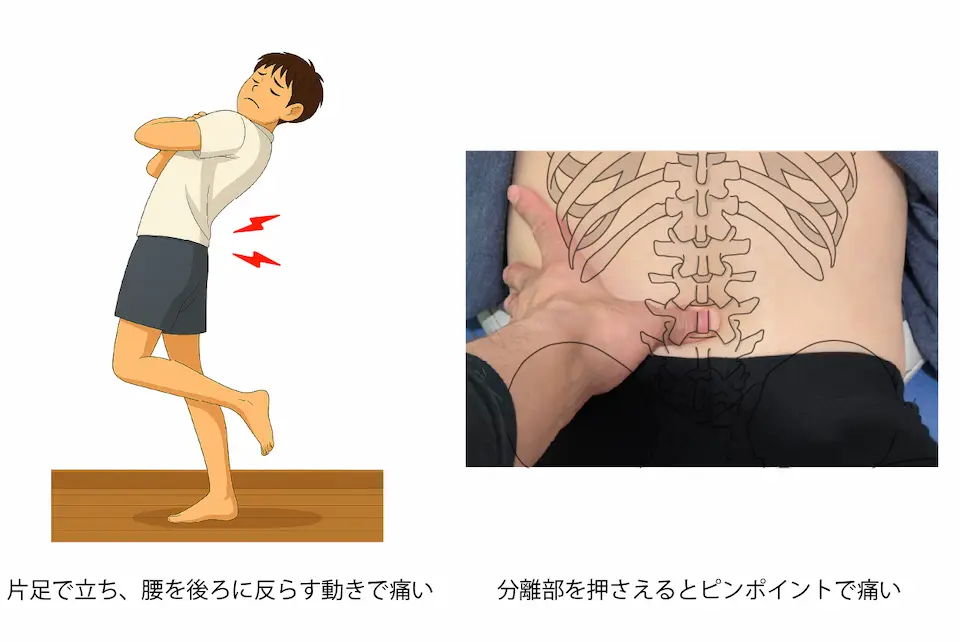 分離症の検査 