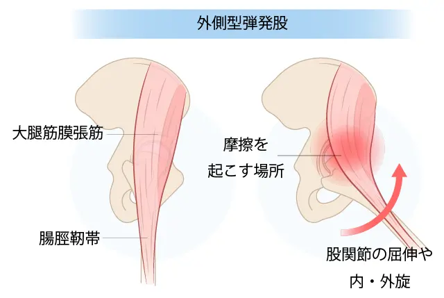 外側型弾発股のイラスト