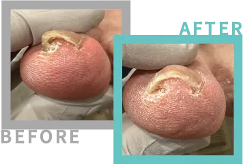巻き爪治療BEFORE-AFETR10