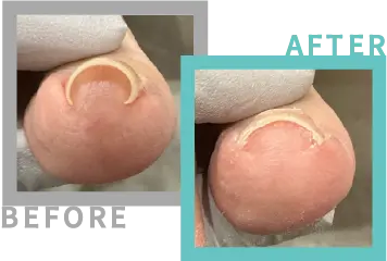 巻き爪治療BEFORE-AFETR11