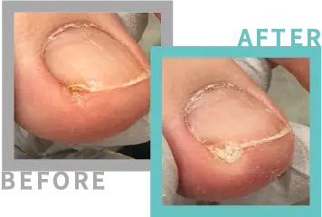 巻き爪治療BEFORE-AFETR13