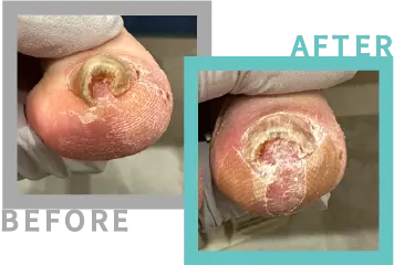 巻き爪治療BEFORE-AFETR14