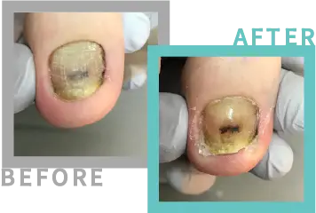 巻き爪治療BEFORE-AFETR16