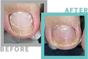 巻き爪治療BEFORE-AFETR17