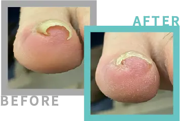 巻き爪治療BEFORE-AFETR18