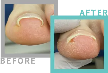 巻き爪治療BEFORE-AFETR22