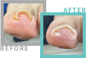 巻き爪治療BEFORE-AFETR25