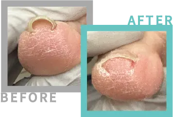 巻き爪治療BEFORE-AFETR40
