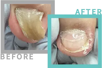 巻き爪治療BEFORE-AFETR51