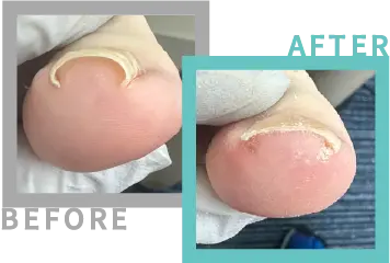 巻き爪治療BEFORE-AFETR52