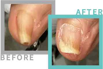 巻き爪治療BEFORE-AFETR65