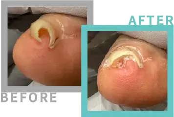 巻き爪治療BEFORE-AFETR66