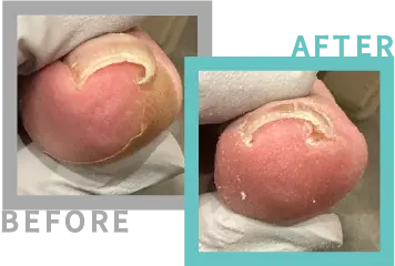巻き爪治療BEFORE-AFETR73