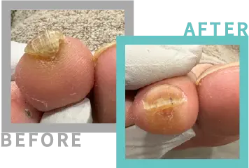 巻き爪治療BEFORE-AFETR80