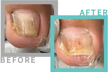 巻き爪治療BEFORE-AFETR81