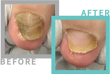 巻き爪治療BEFORE-AFETR83