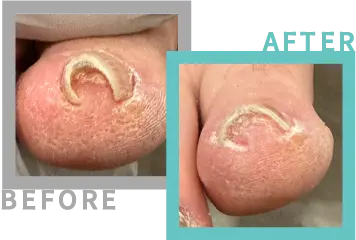 巻き爪治療BEFORE-AFETR88