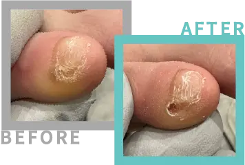 巻き爪治療BEFORE-AFETR92