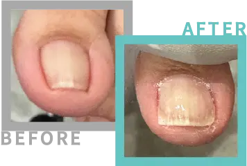 巻き爪治療BEFORE-AFETR94