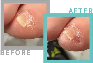 巻き爪治療BEFORE-AFETR96