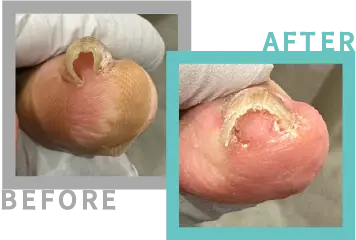 巻き爪治療BEFORE-AFETR③