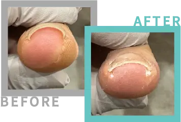 巻き爪治療BEFORE-AFETR④