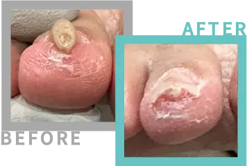 巻き爪治療BEFORE-AFETR⑨