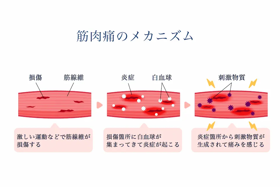 筋肉痛のメカニズム